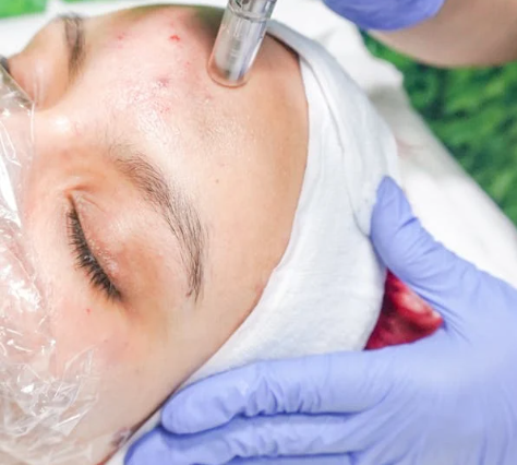 Acne Therapy Facial